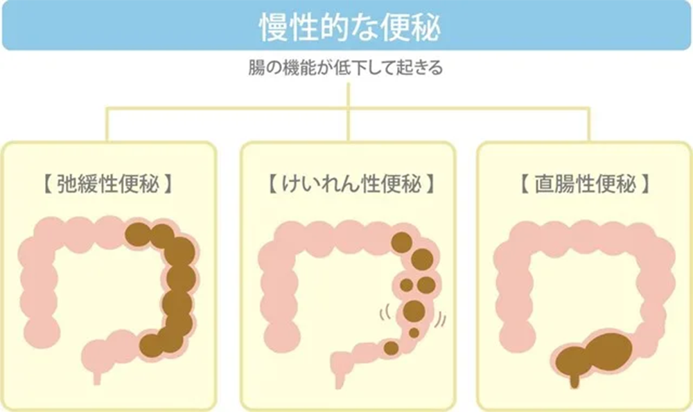 「便秘」を解消する新常識!温故知新の体内クレンズ法