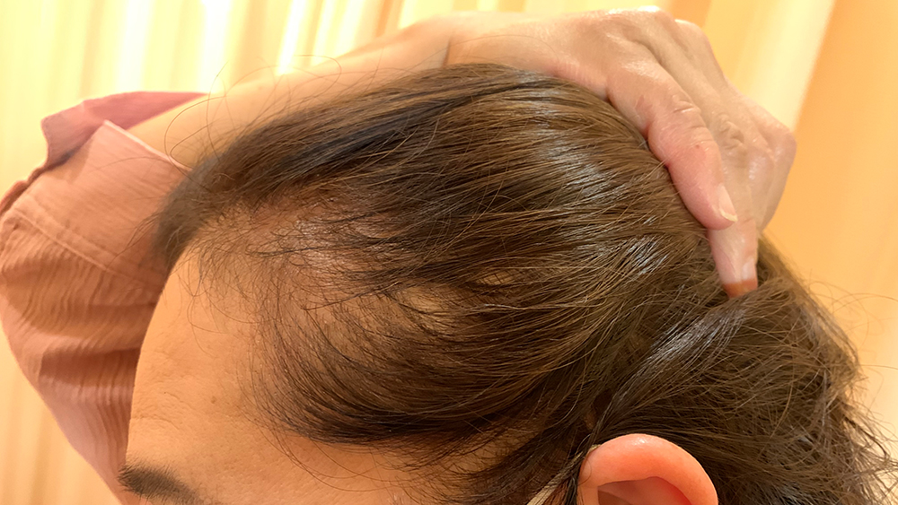 気になる髪の毛の悩み…薄毛・抜け毛対策