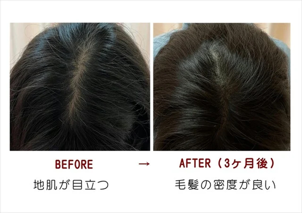 鍼灸治療で薄毛・抜け毛の治療ができる