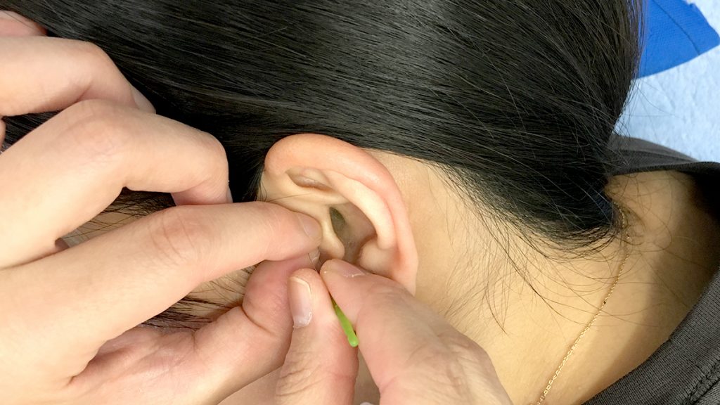 妊娠中の突発性難聴