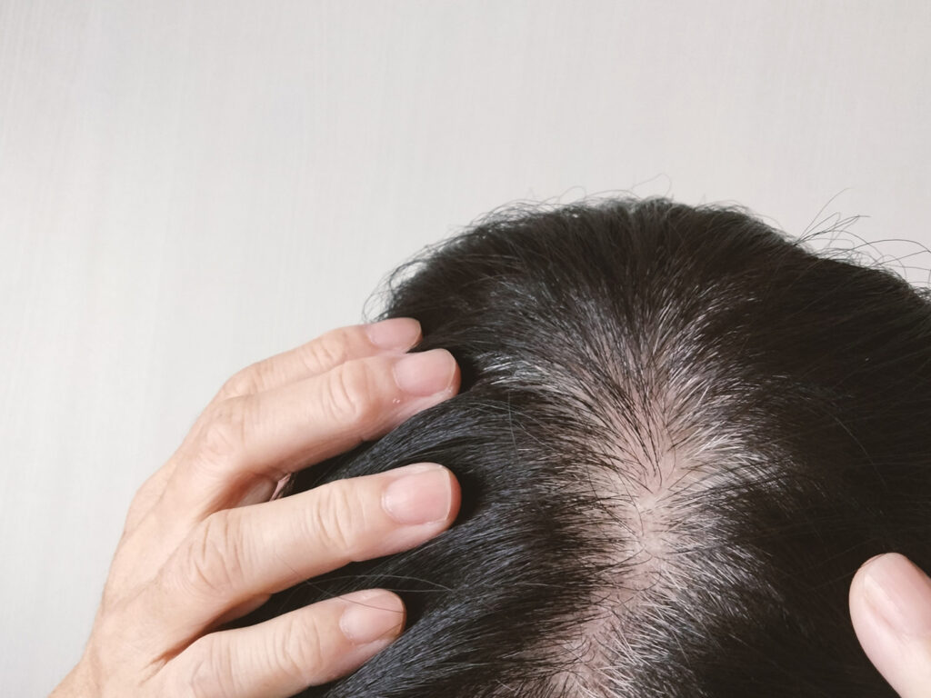 レディース抜け毛専門外来