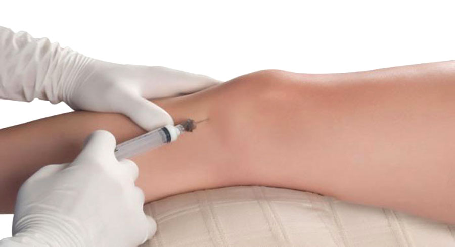 膝の再生医療PRP療法と鍼灸トレーニング